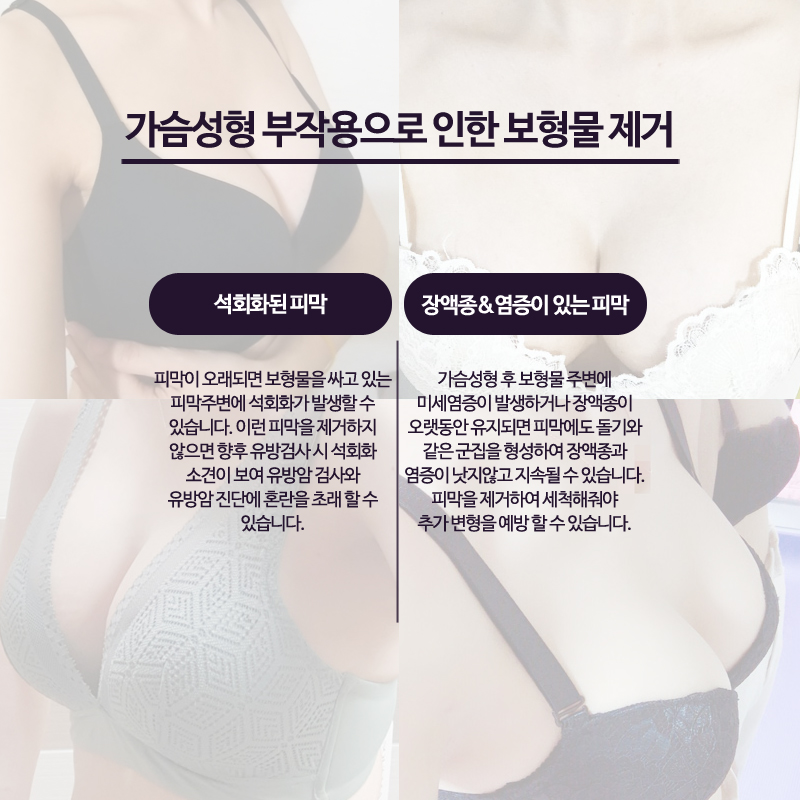 Breast Implant Removal Should Be Done Delicately and Accurately image 6