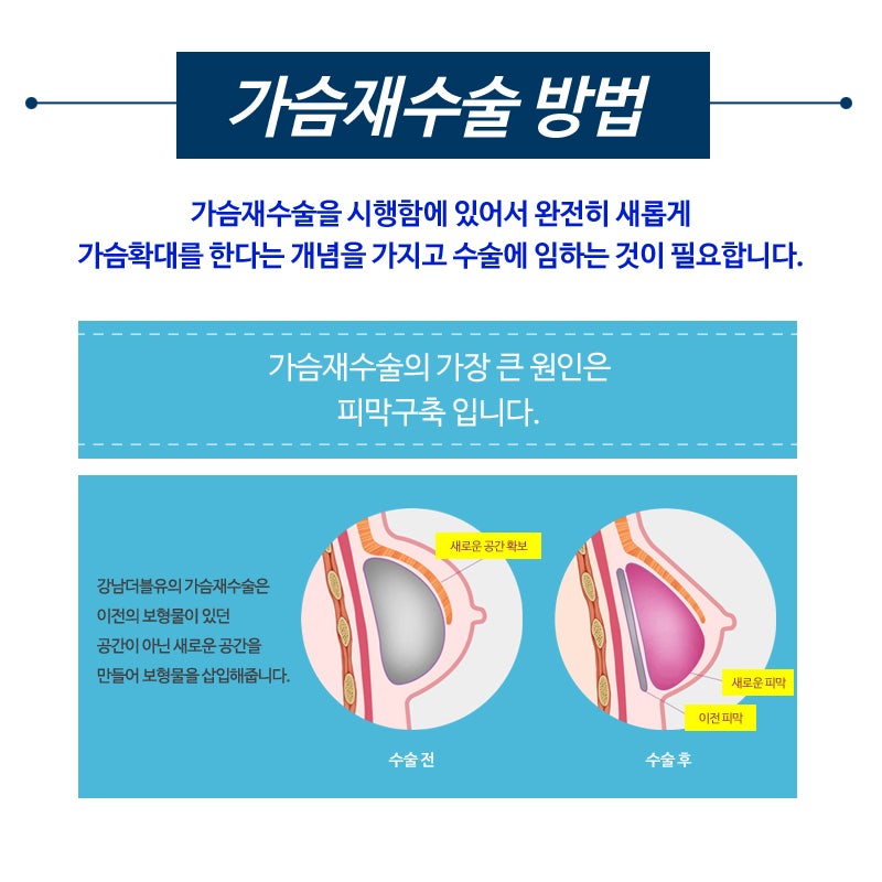 가슴재수술 올바른 시기 잘 따져봐야 한다 관련 이미지 2