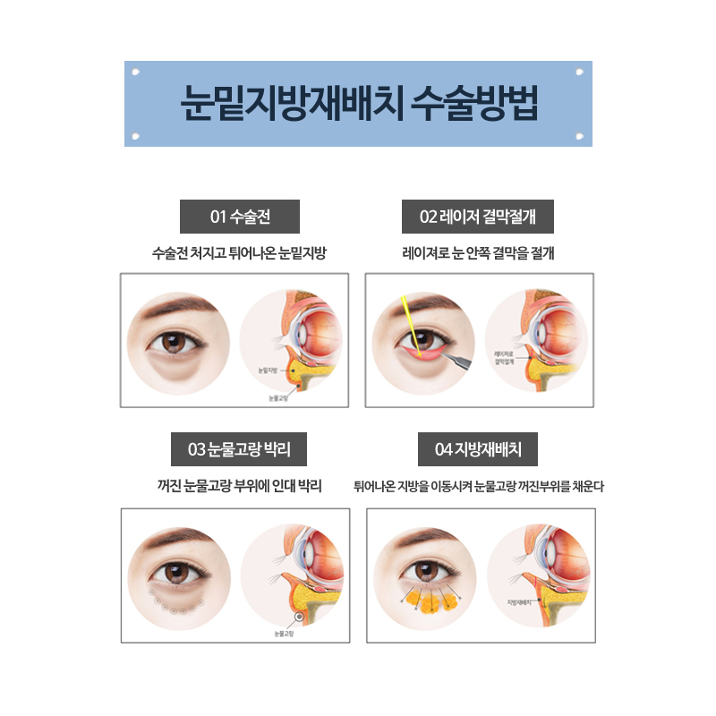 What Kind of Surgery Is Under-Eye Fat Repositioning? image 4