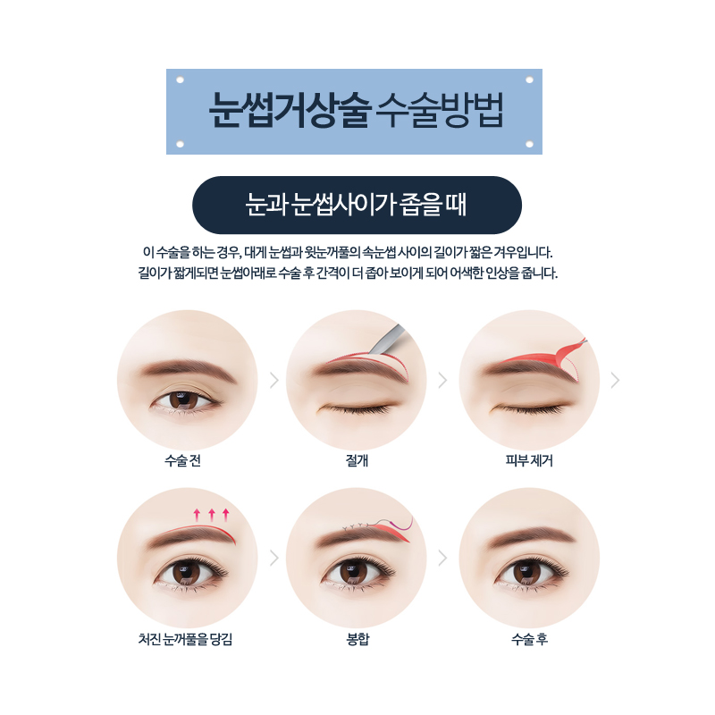 Middle-Age Eye Surgery: A Natural Youthful Eye Shape with Eyebrow Lift Surgery image 4