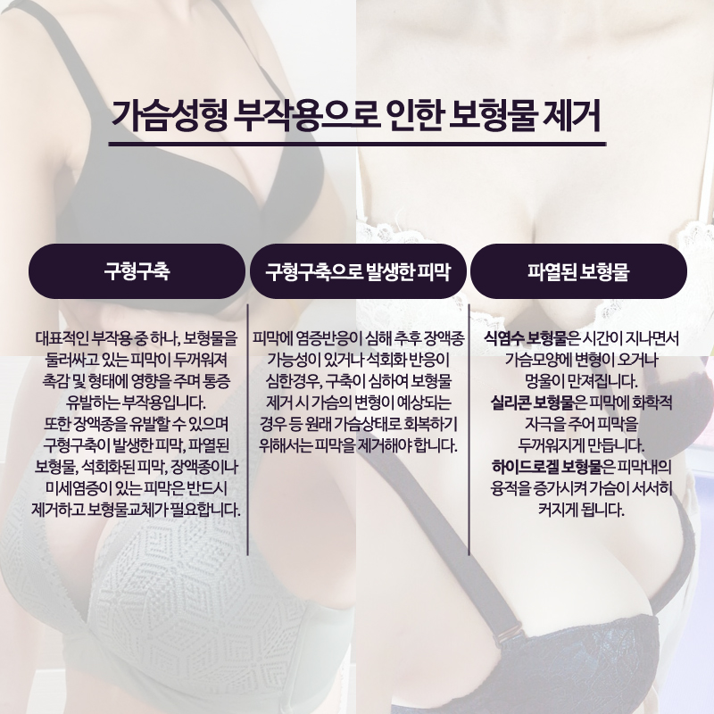 Breast Implant Removal Should Be Done Delicately and Accurately image 5
