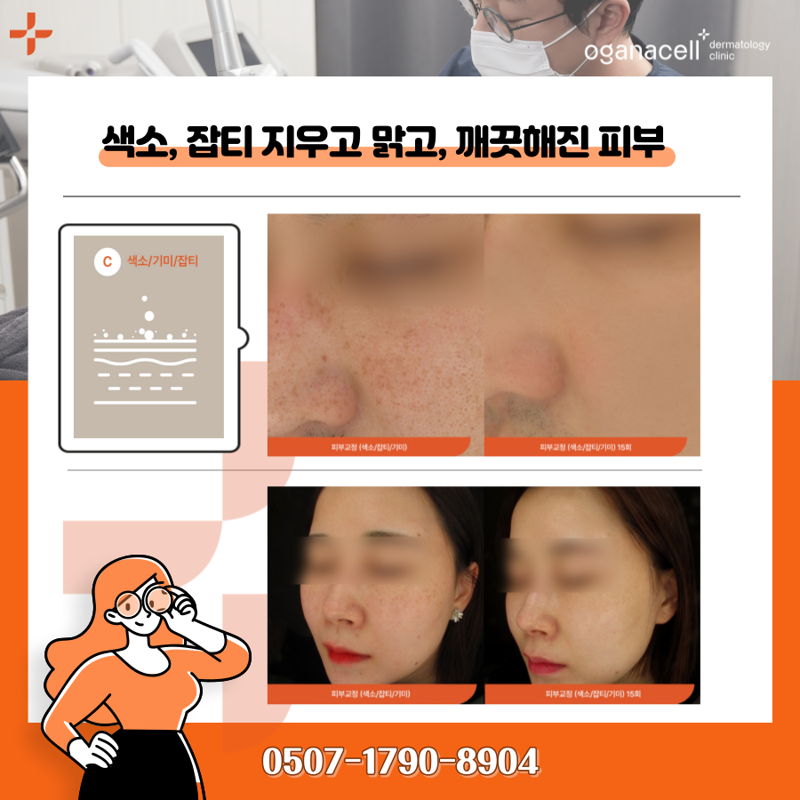 기미제거레이저 토닝 유명한곳 가격은 관련 이미지 9