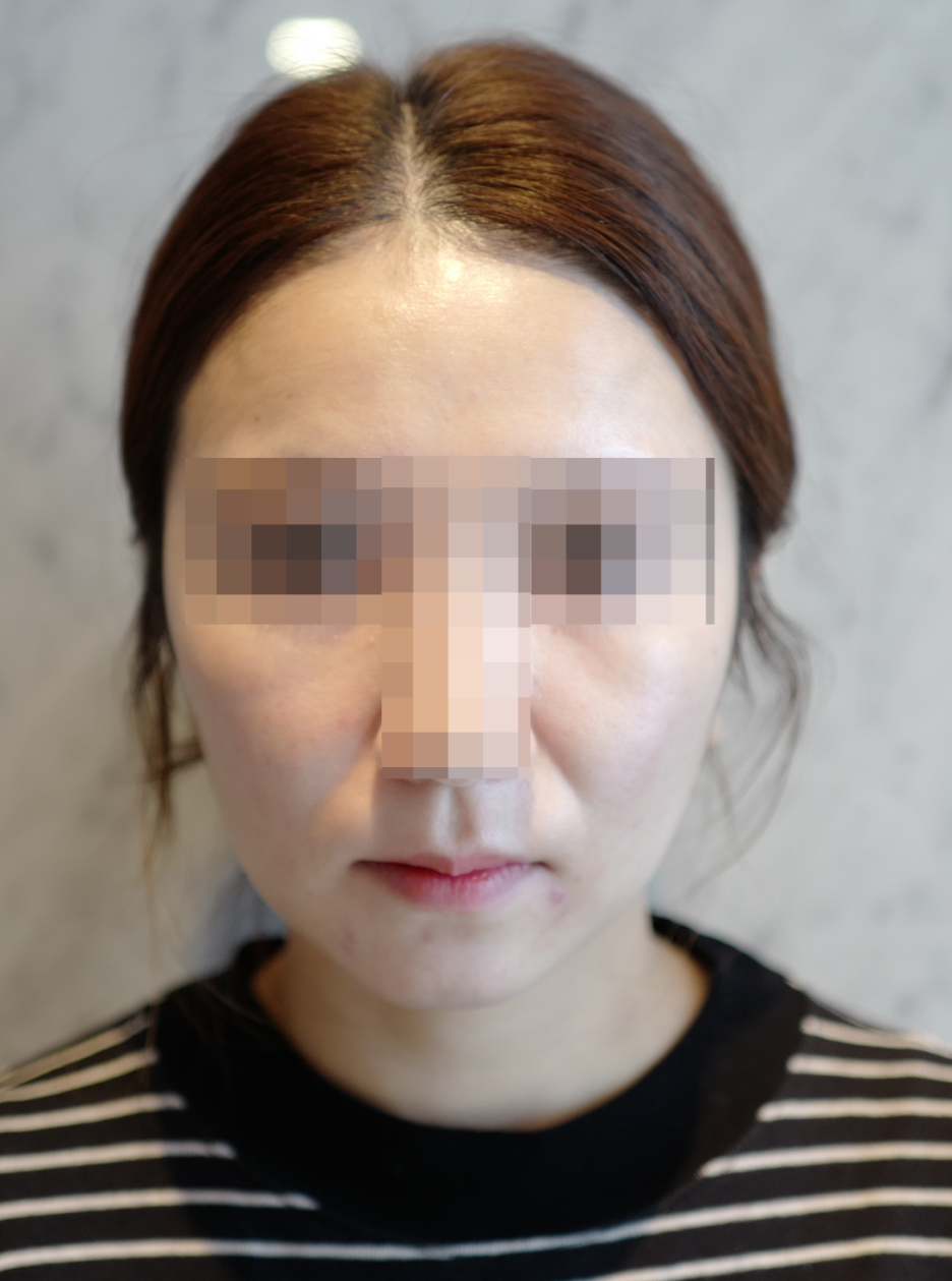 30대 여성 피부 개선 전략 - 울쎄라, 필러 시술 후기 관련 이미지 2