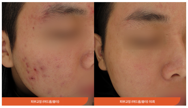 여드름 흉터 피부과, 롤링성 패인 흉터, 관련 자주 묻는 질문에 답해드립니다! 관련 이미지 11