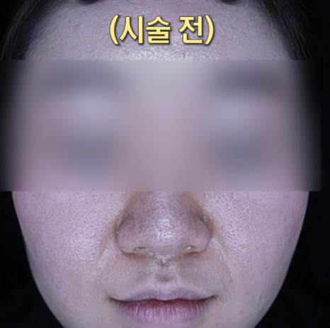 넓은 모공 줄이는 피부과 가성비 시술 소개(feat. 스킨보톡스) 관련 이미지 3