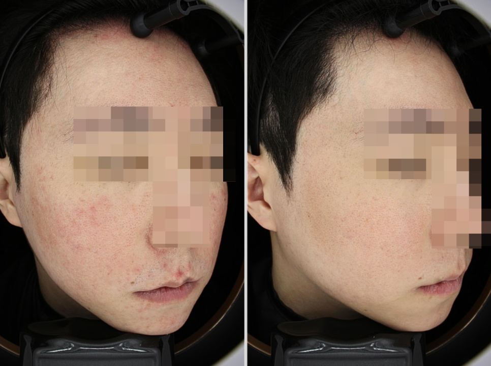 피부장벽 개선, 치료만큼 중요한건 00입니다 관련 이미지 10