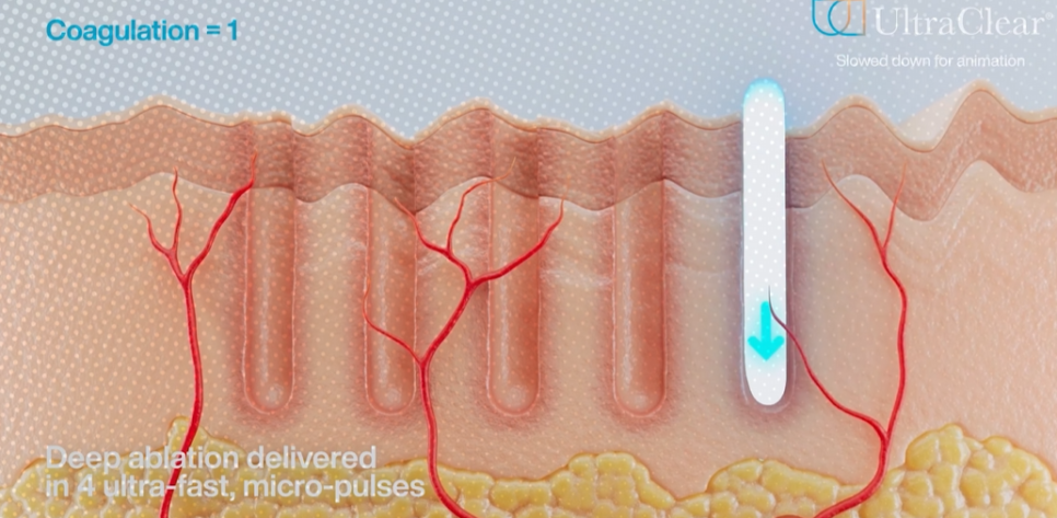 Curetra, Uligo? Introducing a New Procedure Without Worrying About Side Effects image 3