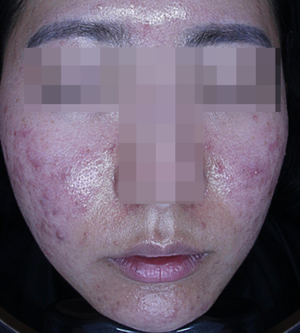 20대 여성 여드름 흉터 레이저 종류와 치료 사례 관련 이미지 2