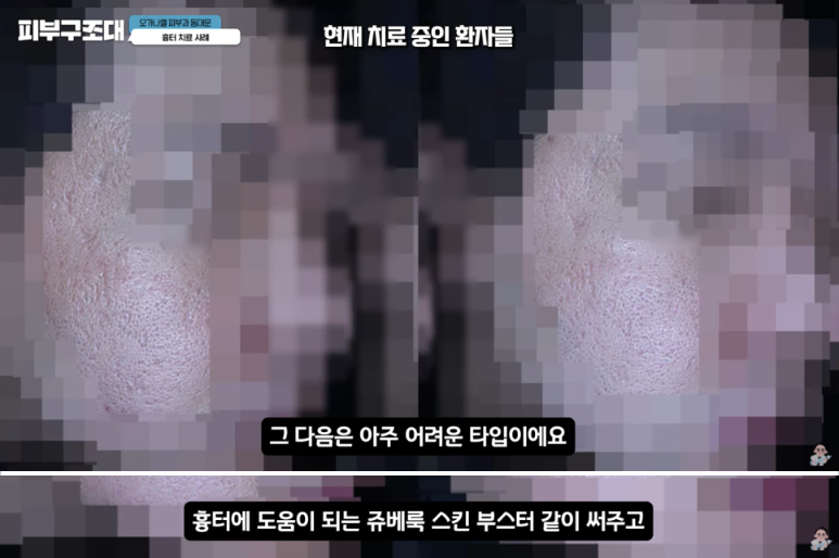 쥬베룩 리쥬란 차이, 동시에 맞아도 될까? 관련 이미지 17