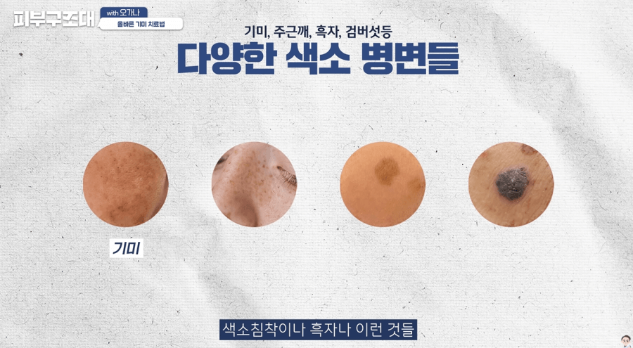 피코슈어레이저 기미 해결 가능할까? 관련 이미지 6