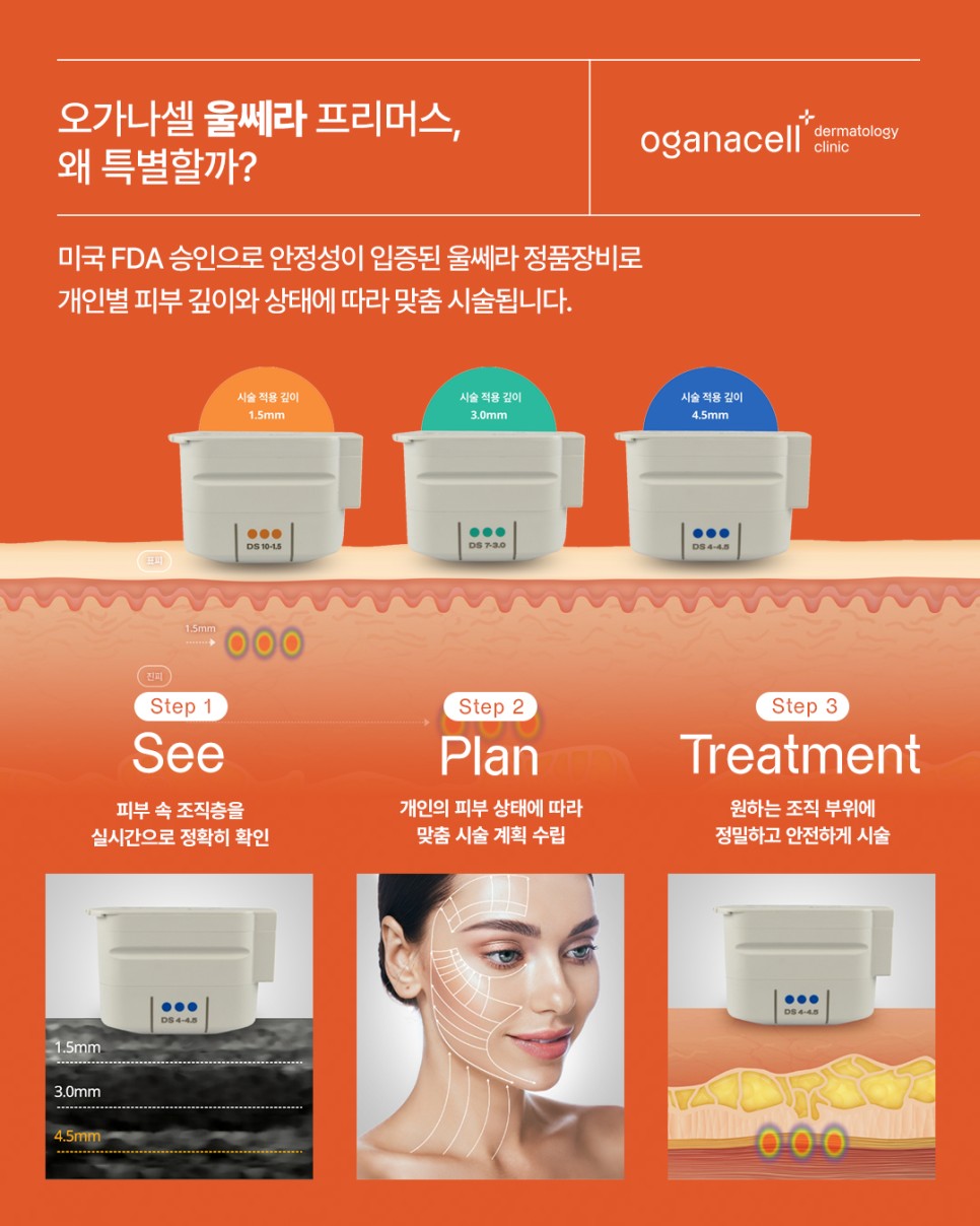 울쎄라 프리머스 리프팅으로 피부 탄력교정 하세요! 관련 이미지 4