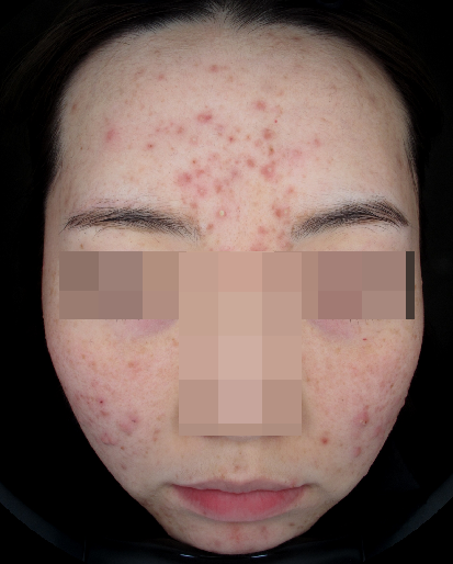 오가나셀 피부과 청담 피부교정 치료 사례 소개 관련 이미지 2