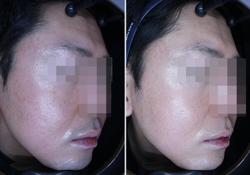 민감성 피부 로션 크림이 효과가 없던 이유 - 피부과 치료 사례 관련 이미지 11