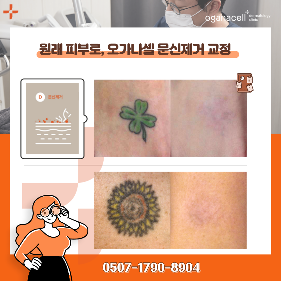 타투지우기 제거 깔끔하게 받으려면 관련 이미지 12
