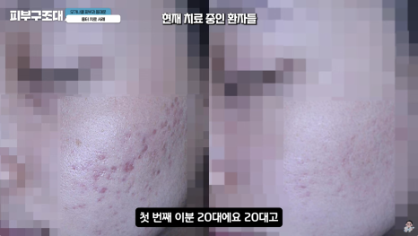 여드름 흉터 쥬베룩 어디까지 좋아질 수 있을까? 관련 이미지 13