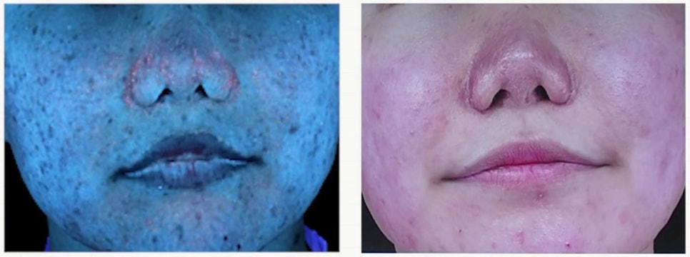 Real Acne Skin Correction Review (Feat. Before/After Photos of Acne in Your 30s) image 1