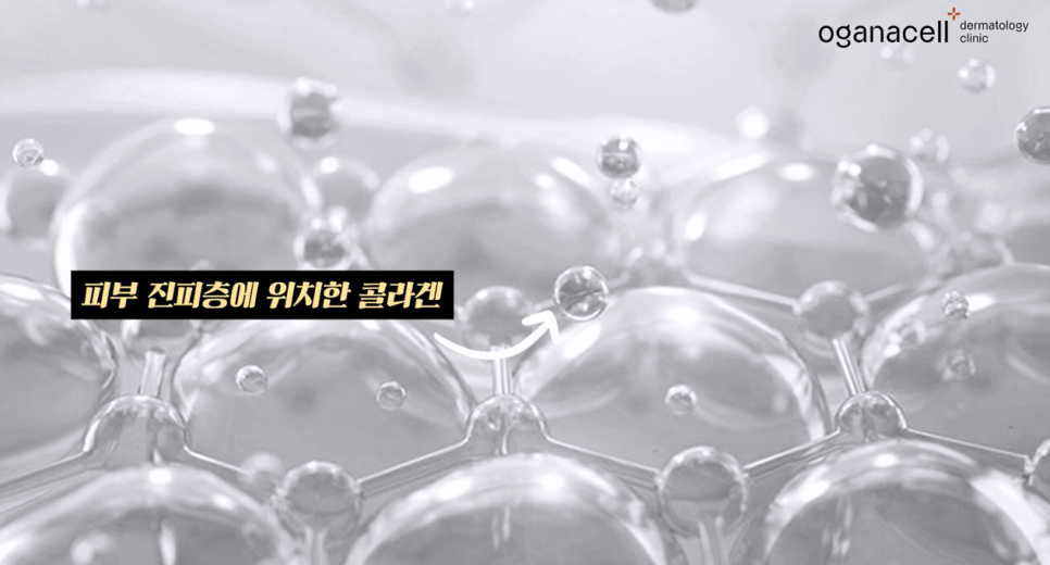 울쎄라 vs 써마지, 내 피부타입에 딱 맞는 리프팅 시술은? 관련 이미지 8