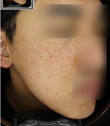 기미잡티치료피부과 찾을 때 확인할 주요사항 2가지 - 전문의 소견 관련 이미지 3