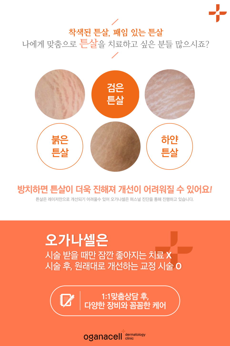 청담역 피부과 튼살레이저 여름대비 관련 이미지 4