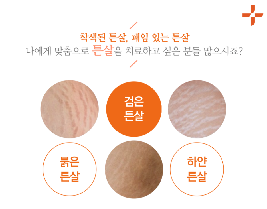허벅지 튼살 치료, 크림만으로는 효과 볼 수 없어요 관련 이미지 12