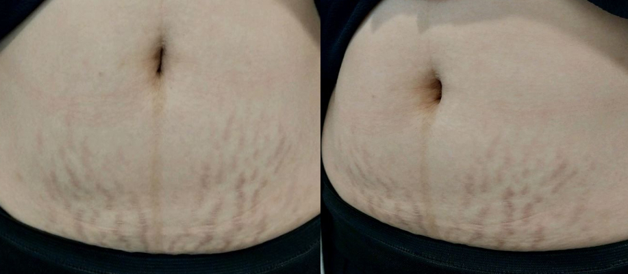 임산부 튼살 크림, 오일로 치료가 힘든 이유 관련 이미지 8