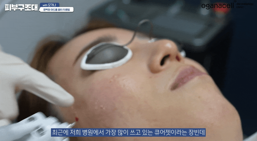 여드름 패인흉터 치료 방법 제대로알자 관련 이미지 16