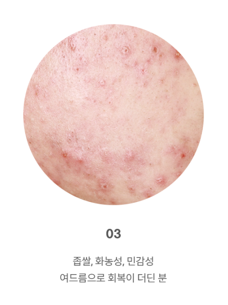 좁쌀 여드름 레이저 시술 전 필독! 이거 알고 받으세요! 관련 이미지 21