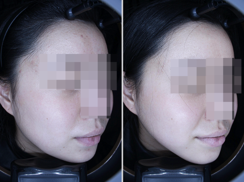 Be Sure to Check These Points for the Full Effects of Cheongdam ONDA Lifting! image 8
