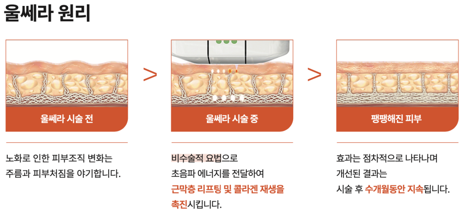 30대 여성 피부 개선 전략 - 울쎄라, 필러 시술 후기 관련 이미지 4