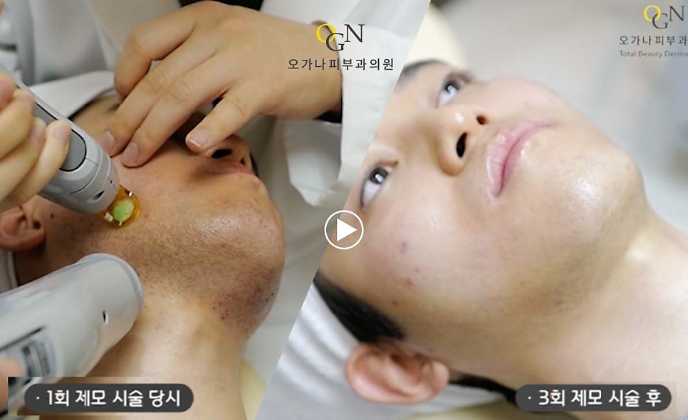 남자레이저제모 주기 고통 알려드려요 관련 이미지 10