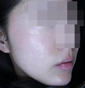 20대 여성 여드름 흉터 레이저 종류와 치료 사례 관련 이미지 12