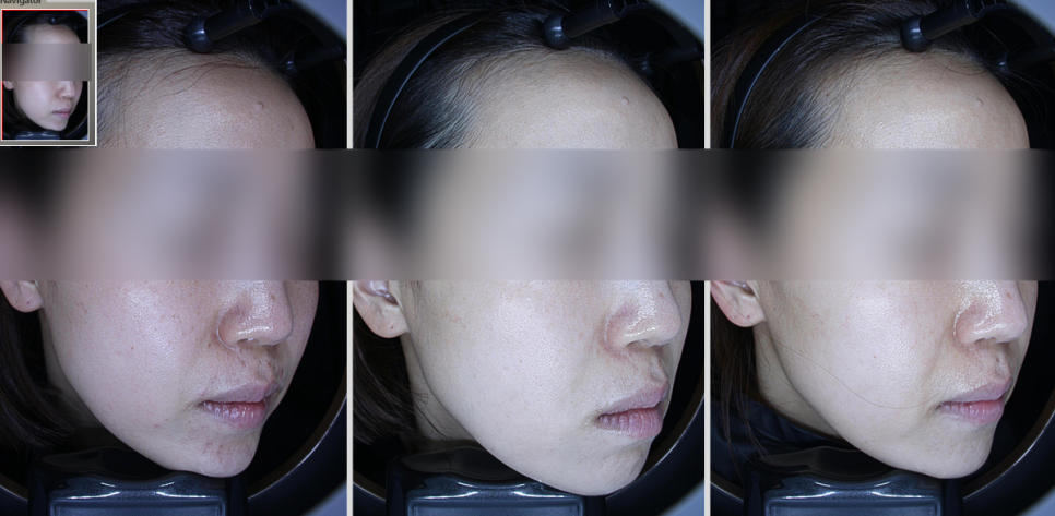 입 주변 여드름 원인, 피부 교정에 답이 있습니다. 관련 이미지 10