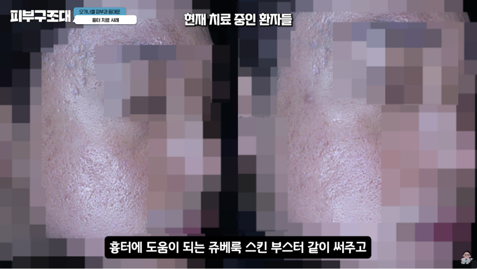 여드름 흉터 쥬베룩 어디까지 좋아질 수 있을까? 관련 이미지 25
