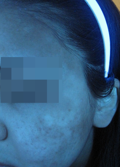 여드름 흉터, 염증 치료 가격만 비교해선 안되는 이유 관련 이미지 10
