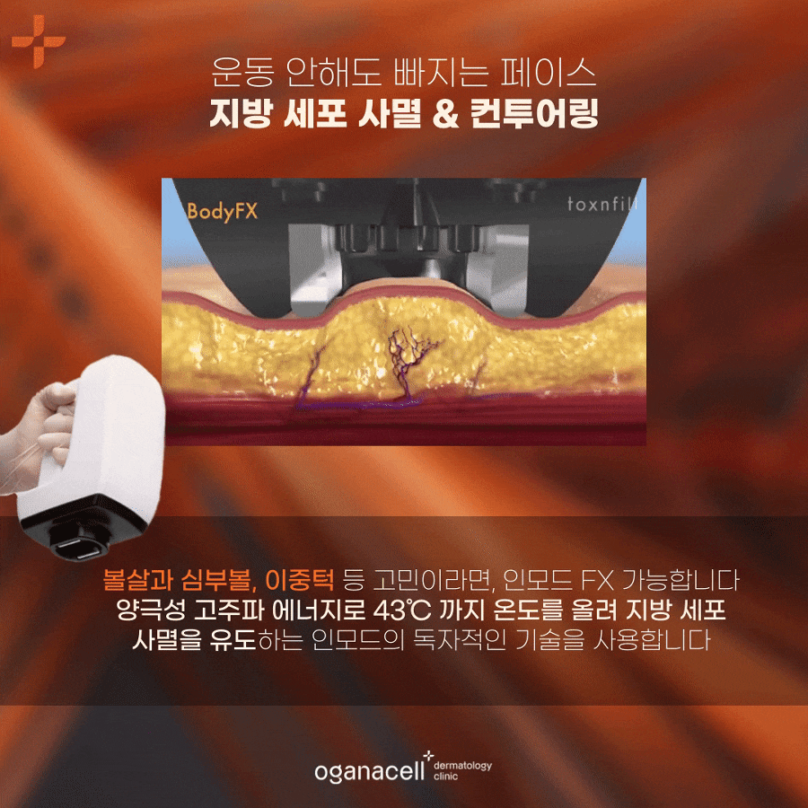 청담 인모드FX V라인완성 통증은? 관련 이미지 6