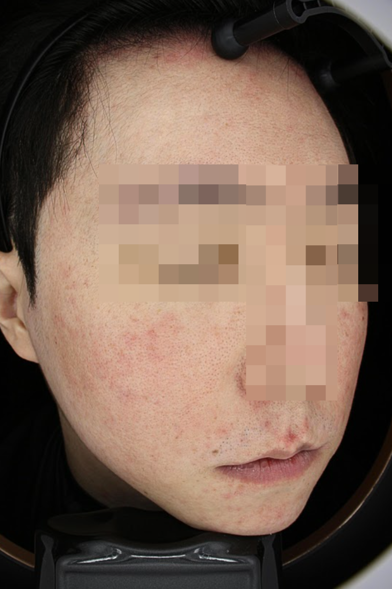 피부장벽 개선, 치료만큼 중요한건 00입니다 관련 이미지 2