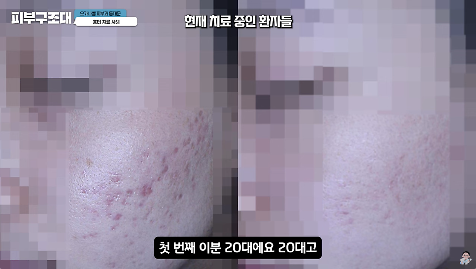여드름 흉터 쥬베룩 어디까지 좋아질 수 있을까? 관련 이미지 16