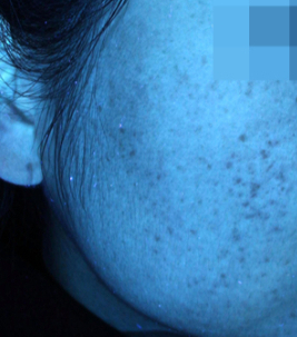 16년 전문의가 소개하는 여드름 흉터 레이저 시술 치료 사례 관련 이미지 9