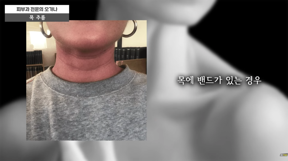 목주름 없애는 법 목주름 시술 알아보기 | 피부과 전문의 오가나 관련 이미지 5