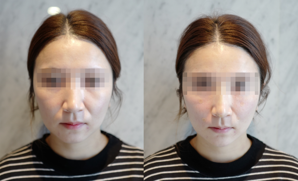 팔자주름실리프팅? 의사가 시술한 실제 후기 관련 이미지 3