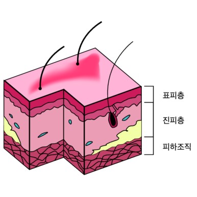 온다 리프팅, 통증에 민감한 분들을 위한 선택지 관련 이미지 4