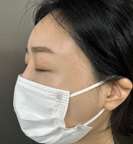 이마 필러 꼭 2가지는 체크해 보시길 당부드립니다. 관련 이미지 9