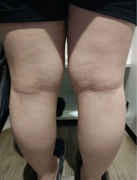 허벅지 튼살 치료, 크림만으로는 효과 볼 수 없어요 관련 이미지 3