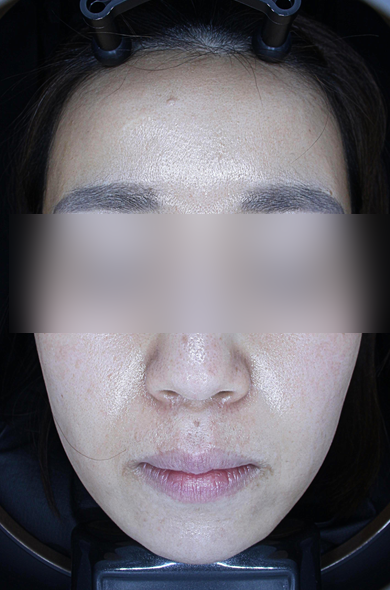입 주변 여드름 원인, 피부 교정에 답이 있습니다. 관련 이미지 13