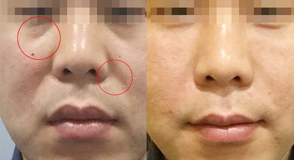 깊은팔자주름? 비싼 돈 들여도 소용 없습니다 관련 이미지 4