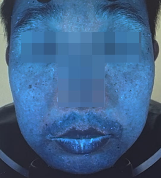 젠틀맥스프로의 숨겨진 효과 - 사례 소개 관련 이미지 3