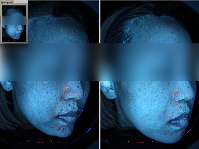 입 주변 여드름 원인, 피부 교정에 답이 있습니다. 관련 이미지 5