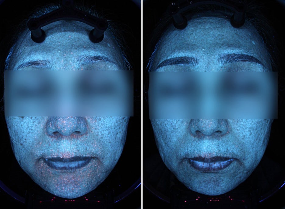 주근깨피부과? 돈만 날리고 효과가 없다면 읽어보세요. 관련 이미지 8