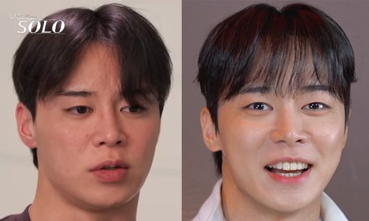나는솔로 30기 영수님, 왜 시술 문의가 많을까요 (feat. 울트라클리어, 올타이트) 관련 이미지 2