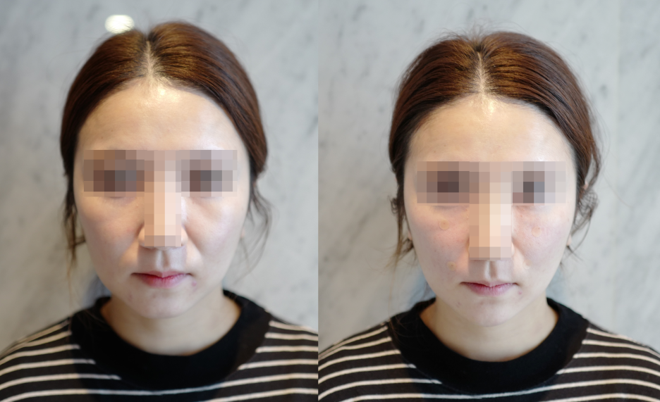 인디언 밴드 주름 필러? 의사가 말해주는 3가지 개선 전략 관련 이미지 9